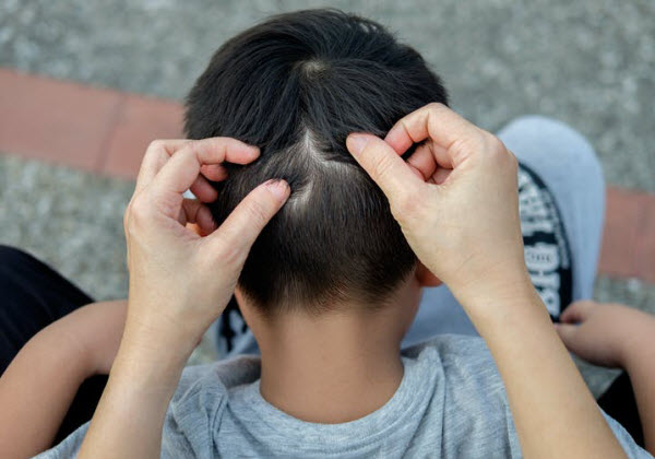 DG - A boy with head lice